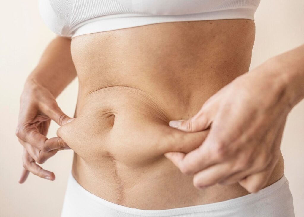 Tummy Tuck Surgery in Karnal