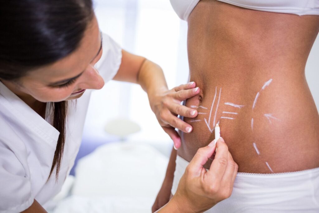 Liposuction Surgery in Karnal