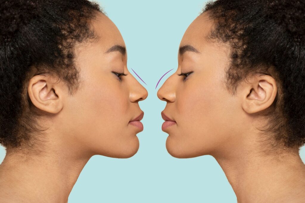 Rhinoplasty Surgery in Karnal