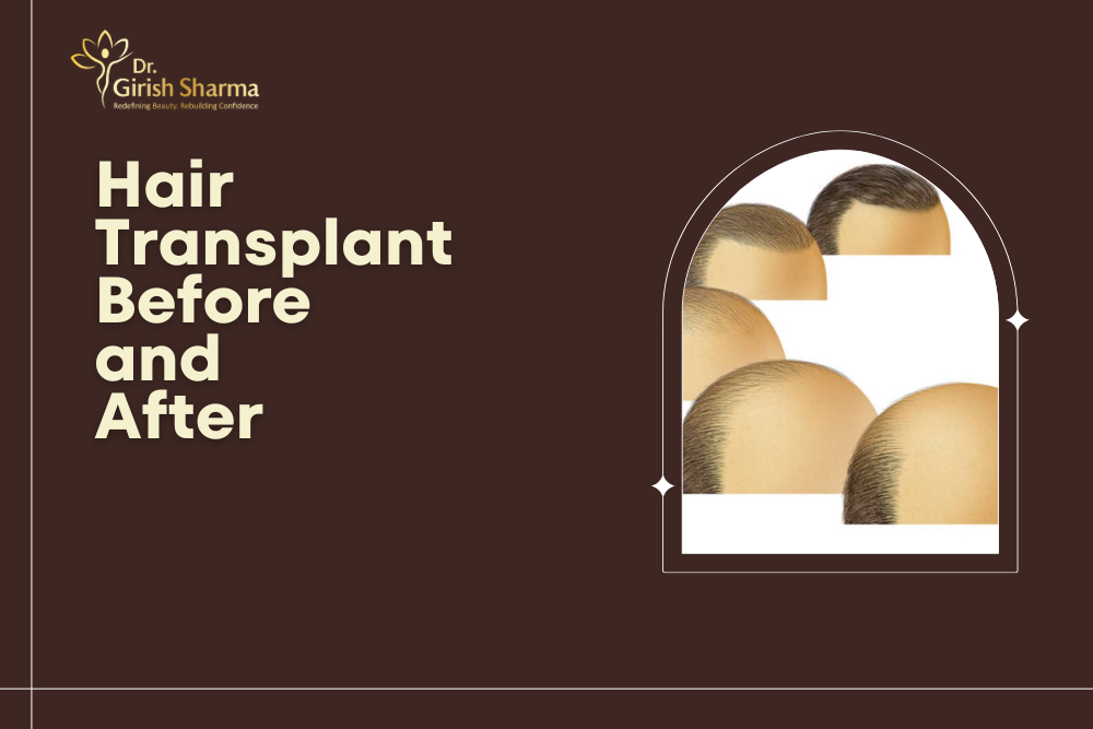 Hair Transplant Before and After