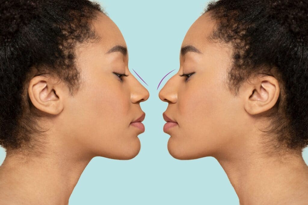 Rhinoplasty Surgery in Karnal